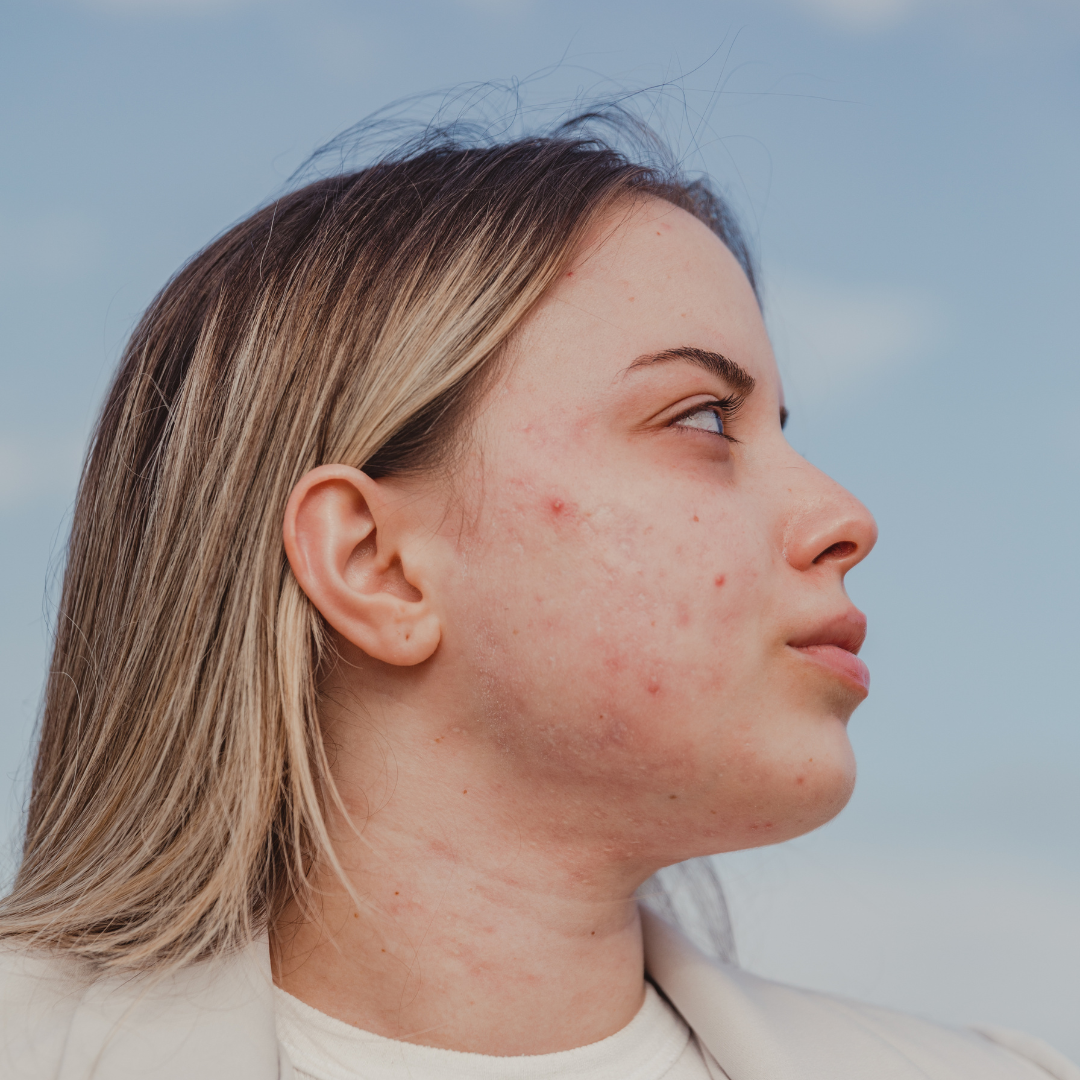 Benefits of CBD for the skin